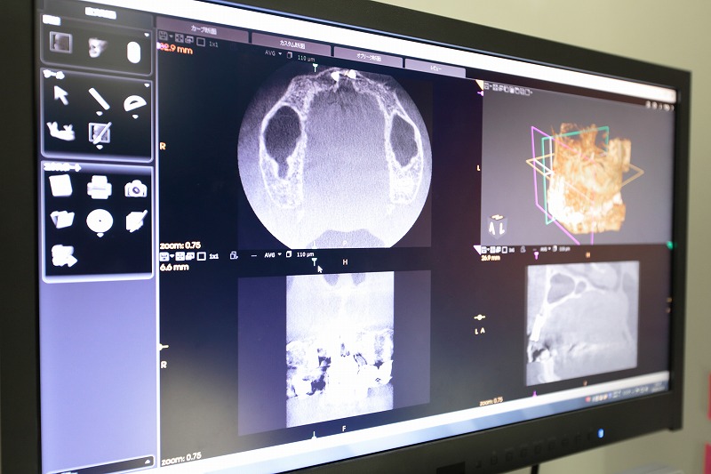 歯科用CTで正確に診断